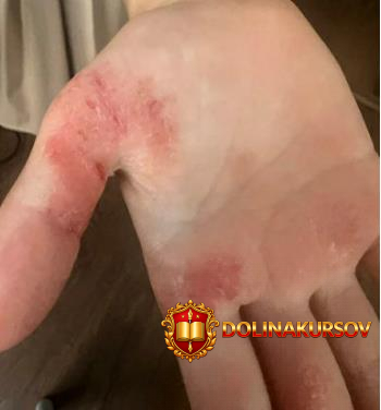 atopicheskij-dermatit-ekaterina-goncharova.466949.jpg